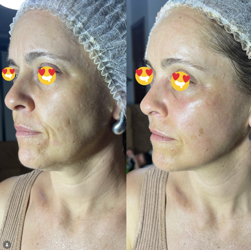 Resultado real antes e depois